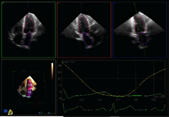 3 Dimensional Left Ventricular and Left Atrial Ejections Fraction