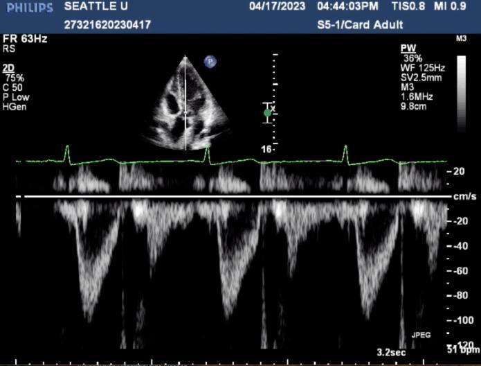 Left Ventricular Outflow Tract