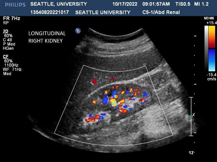 Right Kidney with Blood Flow