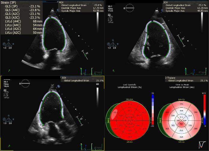 Cardiac Strain