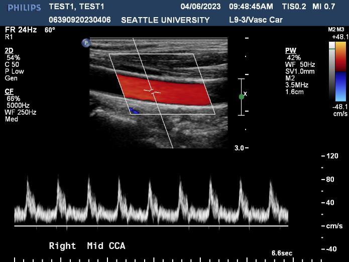 Right Mid Carotid Artery