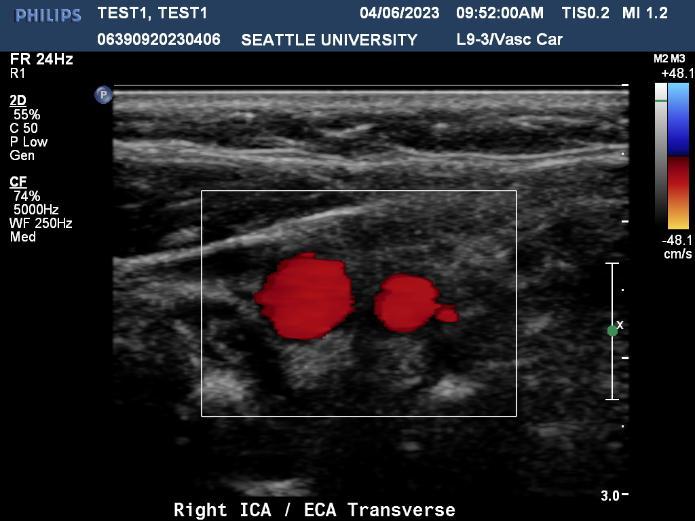 Right Carotid Artery Transverse