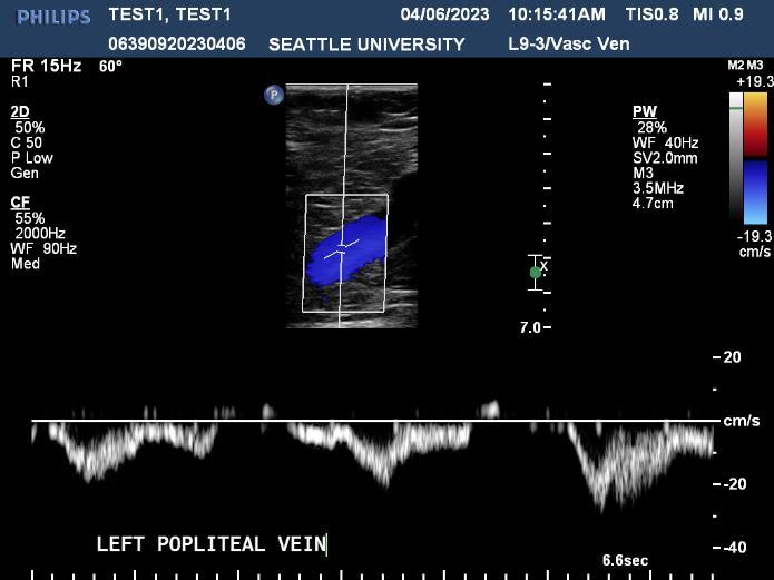 Left Popliteal Vein